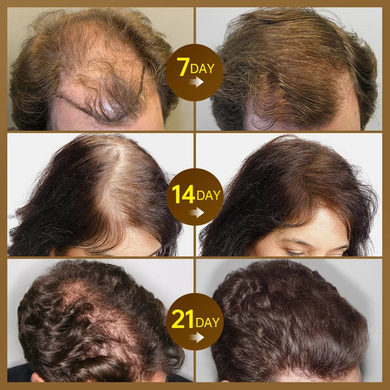 PURC Средства для Роста Волос для Мужчин Имбирное Масло Против Выпадения Волос, Ускоряющее Отрастание, Утолщающее Кожу Головы, Сыворотка Для Ухода За Волосами Для Женщин